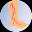 Varicose Veins